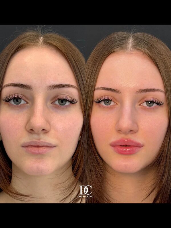 Фото до и после Контурная пластика/Radiesse, материал 7